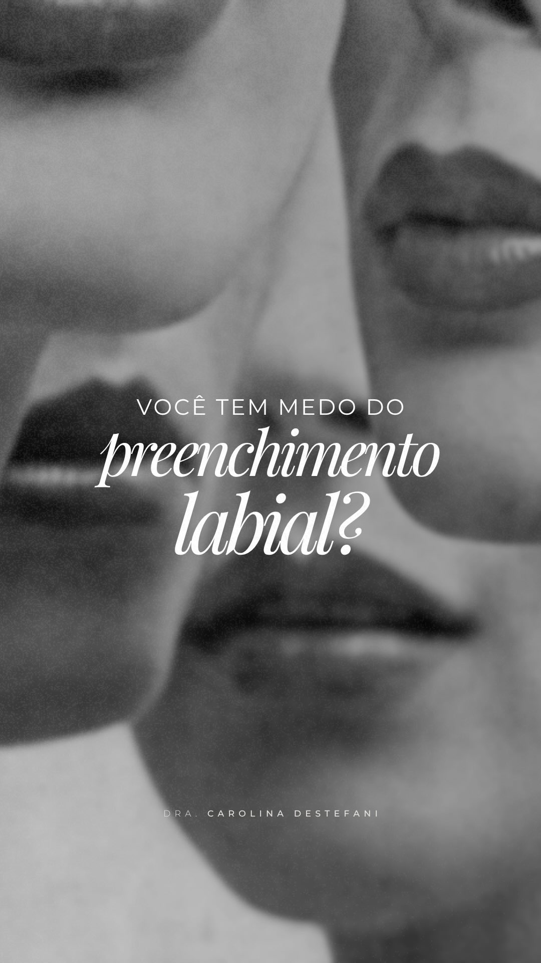 Publicação do Instagram sobre preenchimento labial com naturalidade